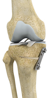 Knee Realignment Surgery