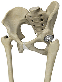 Primary Hip Replacement