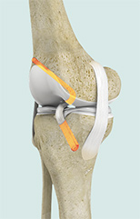 Ligament Reconstruction