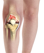 Arthritis of Knee Joint