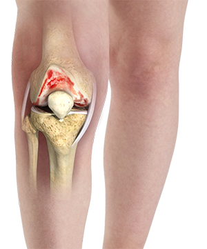 Arthritis of Knee Joint