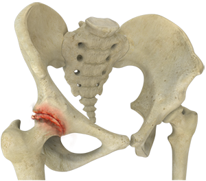 Hip Arthritis