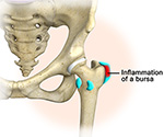 Hip Bursitis