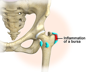 Hip bursitis