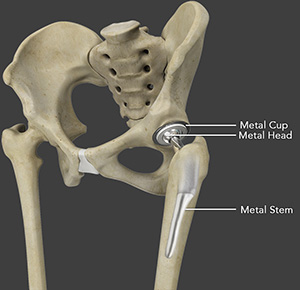 Primary Hip Replacement