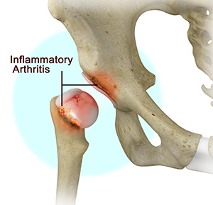 Inflammatory Arthritis