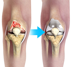 Knee Replacement