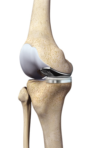 Unicompartmental Knee Replacement