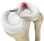 Meniscal injuries