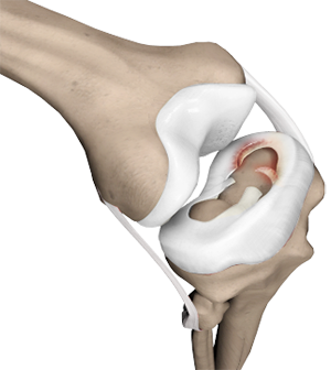 Meniscal Tear