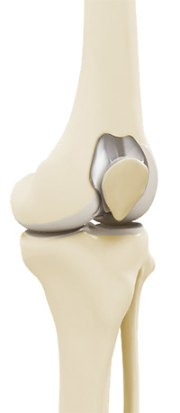 Unicompartmental Knee Replacement