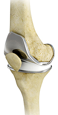 Knee Replacement