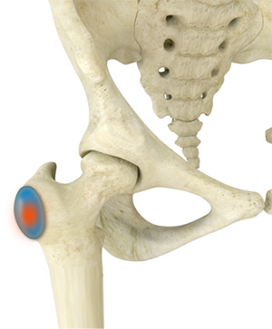 Trochanteric Bursitis